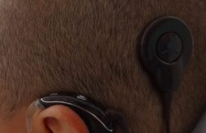 Sassari, all’Aou bambino di 7 anni riceve il primo orecchio ‘bionico’