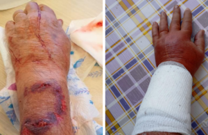 Pirri, violenta aggressione: uomo azzannato da un cane