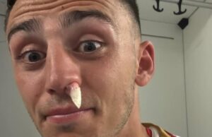 Zappa, che botta! Il difensore scherza: “Tre punti in più e… un naso in meno”