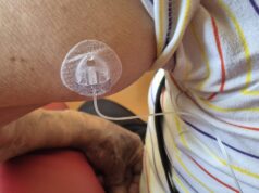 Oristano, impiantato il primo infusore sottocutaneo di levodopa per il Parkinson