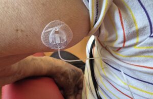 Oristano, impiantato il primo infusore sottocutaneo di levodopa per il Parkinson