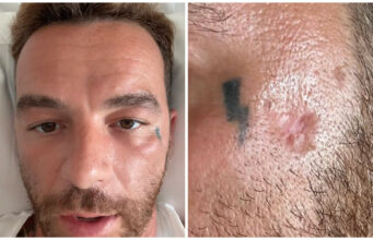 Salmo: “Ho un cancro della pelle, colpa delle creme solari” | È polemica